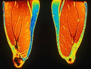 Magnetic Prints: MRI of Upper Thighs