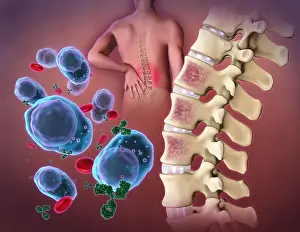 Back Prints: Multiple Myeloma