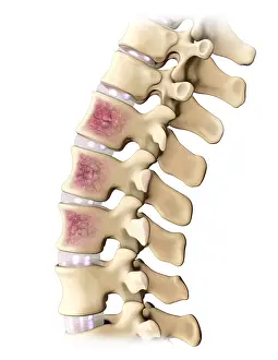 Back Prints: Multiple Myeloma, Spine