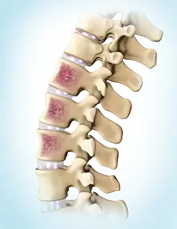 Back Prints: Multiple Myeloma, Spine