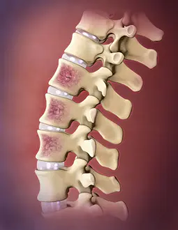 Back Prints: Multiple Myeloma, Spine