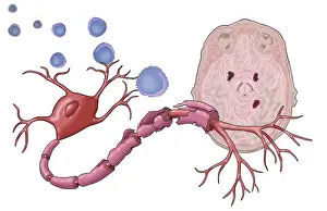Multiple Sclerosis