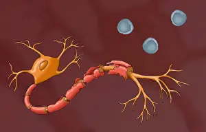 Condition Prints: Multiple Sclerosis