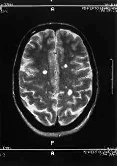 Magnetic Prints: Multiple sclerosis