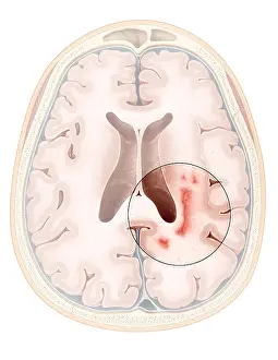 Demyelinating Prints: Multiple Sclerosis