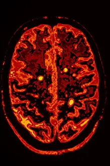 Technology Prints: Multiple sclerosis