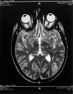 Magnetic Prints: Multiple sclerosis