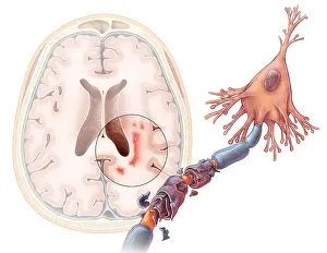 Nerve Prints: Multiple Sclerosis