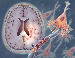 Nerve Prints: Multiple Sclerosis