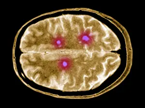 Magnetic Prints: Multiple sclerosis brain lesions