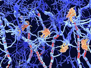 Damage Prints: Multiple sclerosis (MS): microglia cells damage the myelin sheath of neuron axons