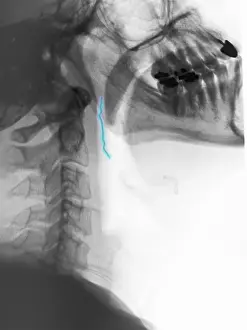 Patient Prints: Neck x-ray of swallowed paper clip