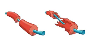 Nerve Prints: Nerve Demyelination of the myelin sheath