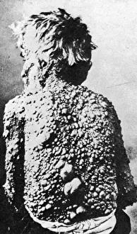 Abdomens Prints: Neurofibromatosis
