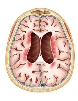 Neurological Prints: Neuronal Ceroid-Lipofuscinosis