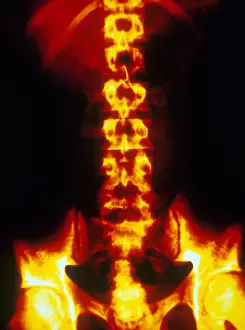 Vertebrae Prints: Normal Abdomen X-ray