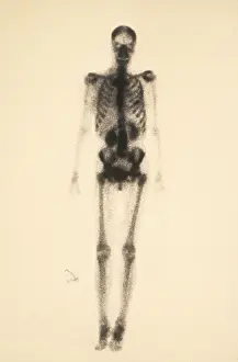 Nuclear Prints: Normal Bone Scan