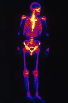 Nuclear Prints: Normal Bone Scan