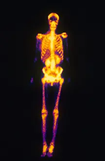 Nuclear Prints: Normal Bone Scan
