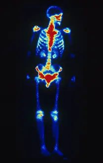 Medical Prints: Normal Bone Scan