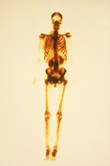 Medical Prints: Normal Bone Scan