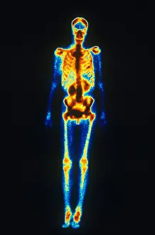 Medical Prints: Normal Bone Scan