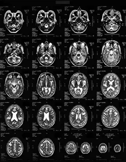 Cerebrum Prints: Normal Brain, 62-Year-Old Woman, MRI