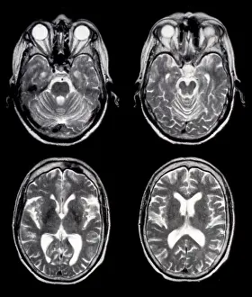 Diagnosis Prints: Normal Brain of 65 Year Old Woman, MRI