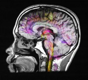 Magnetic Prints: Normal Brain, Fiber Tractography and MRI