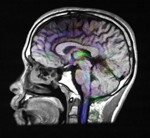 Magnetic Prints: Normal Brain, Fiber Tractography and MRI