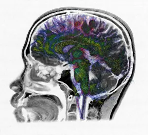 Magnetic Prints: Normal Brain, Fiber Tractography and MRI