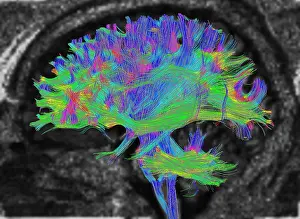 Magnetic Prints: Normal Brain, Fiber Tractography and MRI
