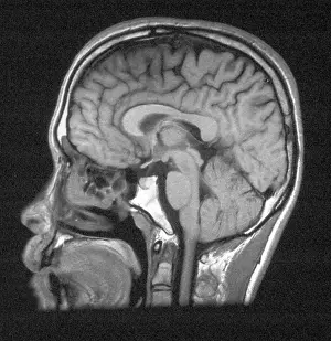 Cross Prints: Normal Brain Structures in Head, MRI