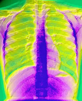 Chest Prints: A normal chest X-ray