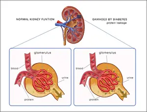 Labeled Prints: Normal and Diabetes-Damaged Kidneys, Illustration