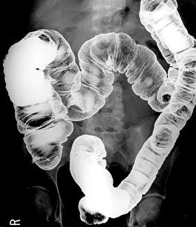 Prints of Radiologic evaluation of the large intestine often involves performing a barium enema : Normal Double Contrast Barium Enema, X-ray, Body Scan