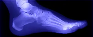 Radiographs Prints: Normal Human Foot