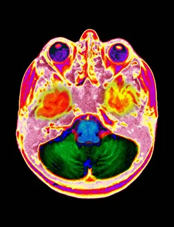 Cerebrum Prints: Normal MRI