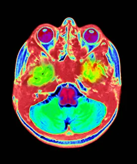Cerebrum Prints: Normal MRI