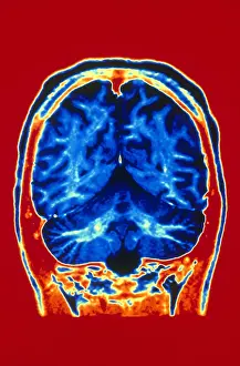 Magnetic Prints: Normal MRI of Brain