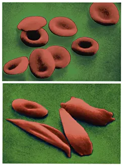 Compare Prints: Normal RBCs and Sickle-Cell Anemia, scanning electron micrograph