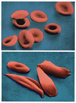 Compare Prints: Normal RBCs and Sickle-Cell Anemia, under a microscope (SEM)