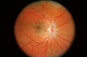 Field Prints: Normal Retina, Ophthalmoscope medical scan