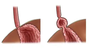 Stomach Prints: Normal Stomach & Stomach with Hiatal Hernia