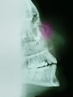 Diagnosis Prints: Nose Fracture