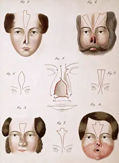 Medical Prints: Nose Reconstruction, 1815 Medical Text