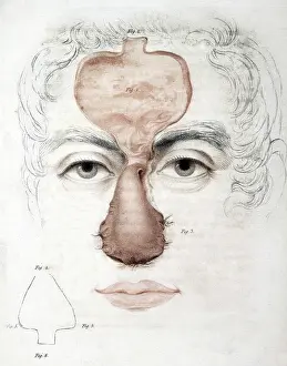 Medical Prints: Nose Reconstruction, 1815 Medical Text