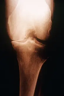 Test Prints: Osteoarthritis, X-ray