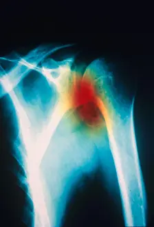 Test Prints: Osteoarthritis, X-ray