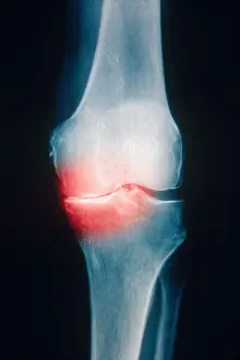 Test Prints: Osteoarthritis, X-ray
